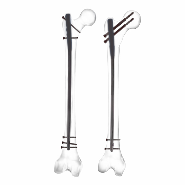 Экспертный бедренный гвоздь