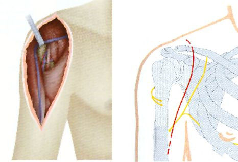 Перелом проксимального отдела плечевой кости