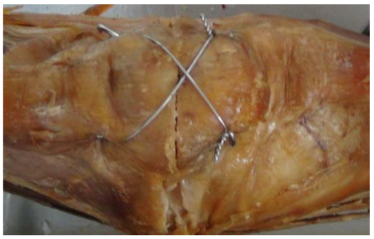 Поперечный перелом надколенника