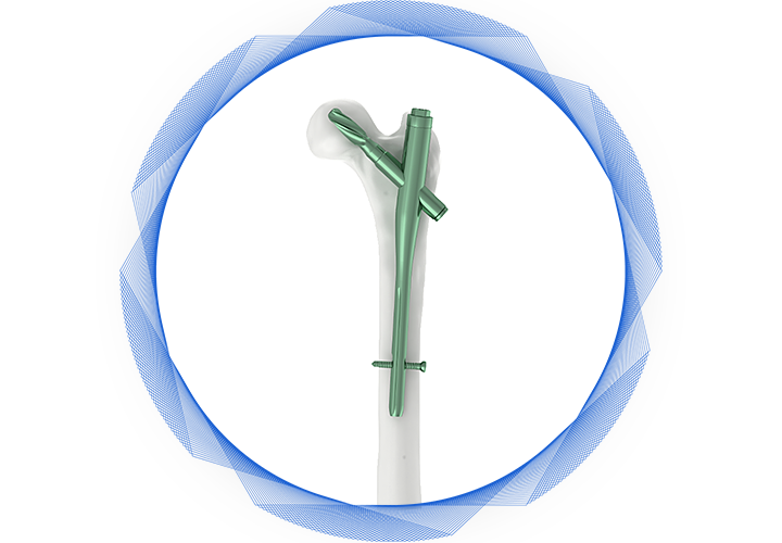 Интрамедуллярный гвоздь