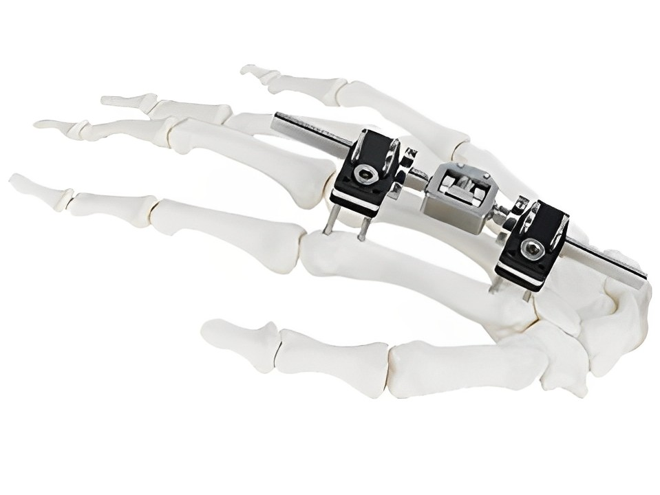 Мини Фиксатор