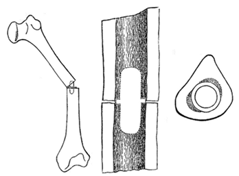 Интрамедуллярный гвоздь
