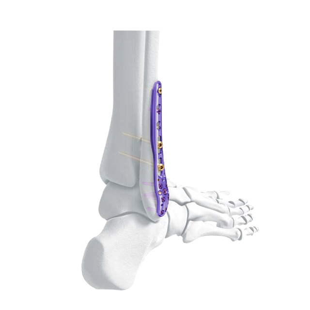 Дистальная боковая фикулярная фиксирующая пластина