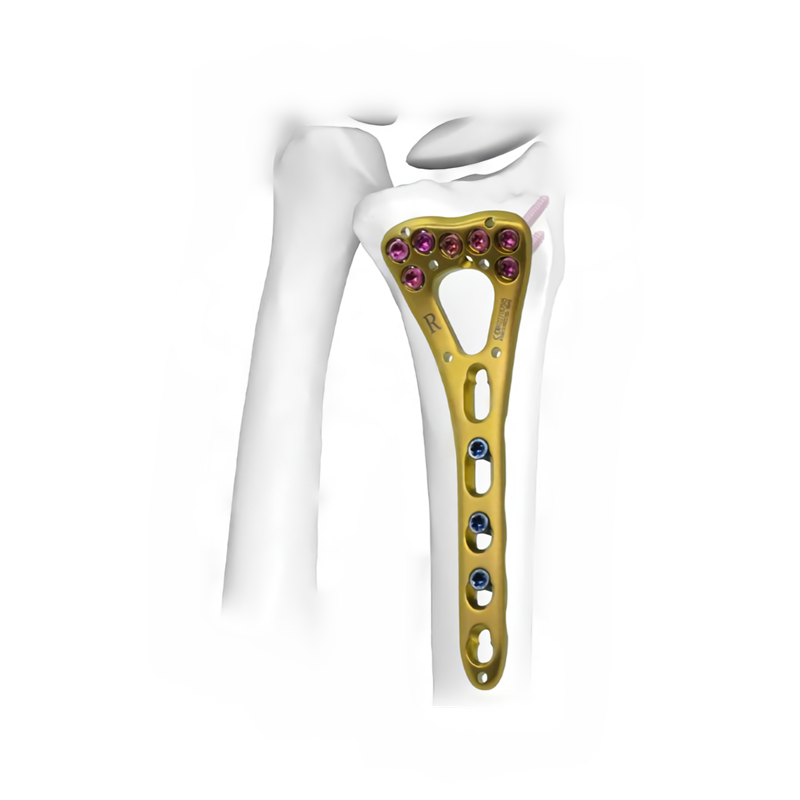 Фиксирующая пластина VA дистального отдела лучевой кости