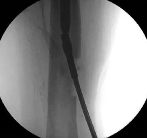 удалить сломанный твердый интрамедуллярный гвоздь