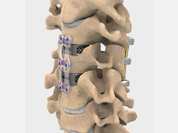 Что такое цервикальные имплантаты?