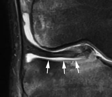 плавающий мениск
