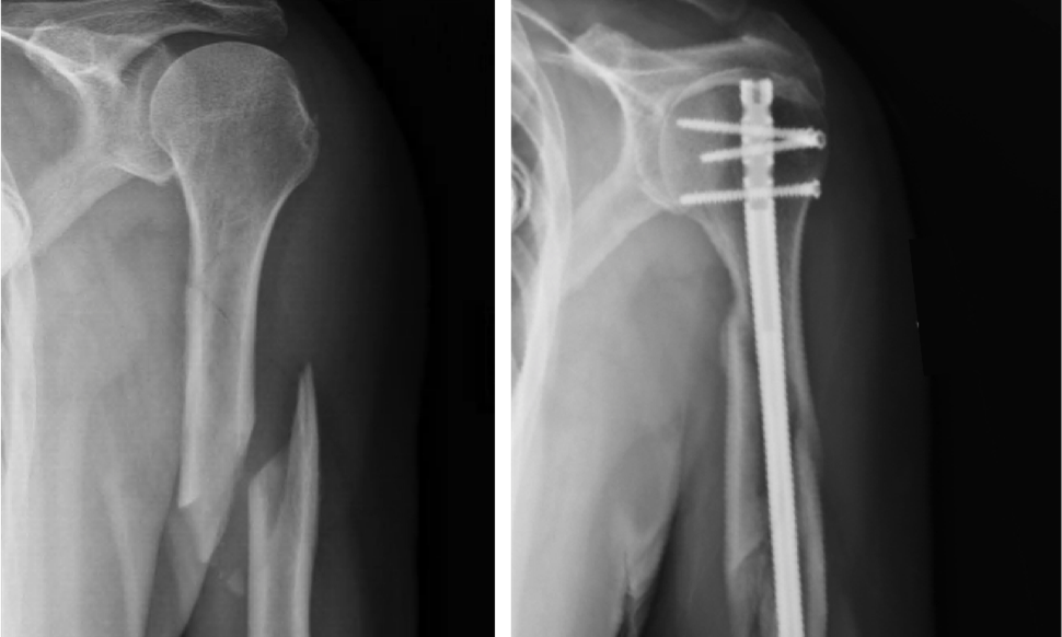 Хирургическое лечение переломов плечевой кости и технических точек