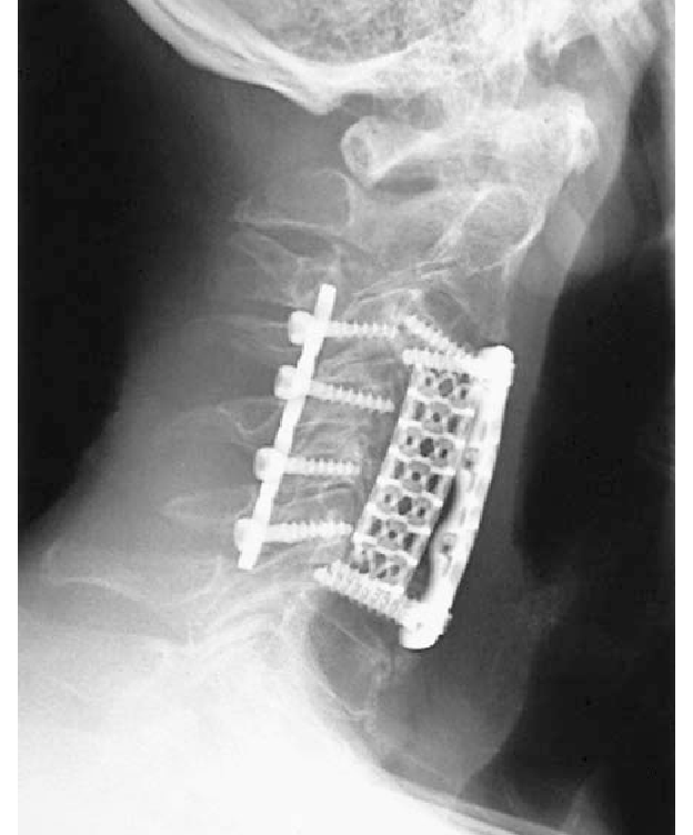 Клетка для позвоночника