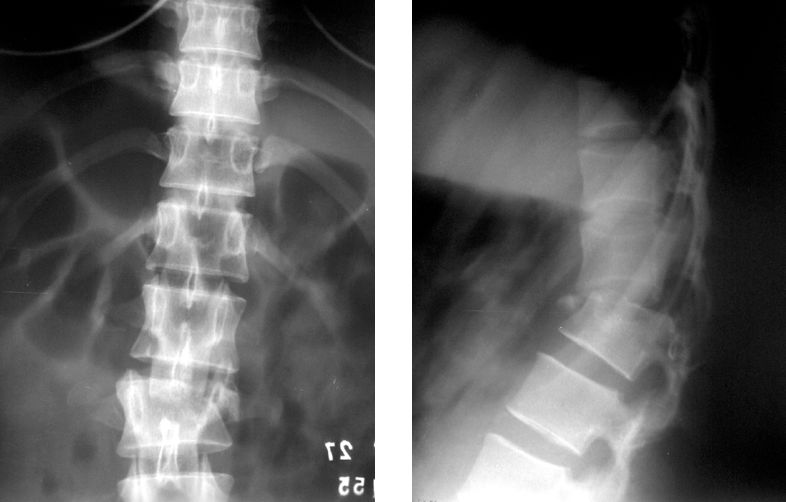 Перелом позвоночника