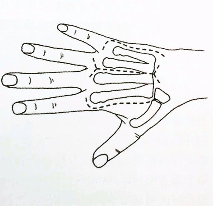 Хирургия ладони