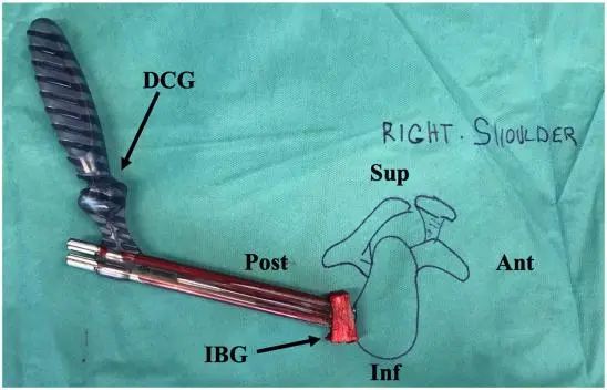 Артроскопическое лечение задней нестабильности плечевого сустава