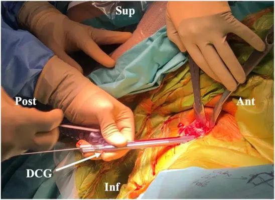 Артроскопическое лечение задней нестабильности плечевого сустава