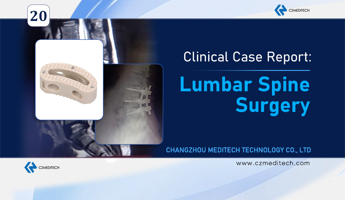 Случай операции TLIF на поясничном отделе позвоночника в Нигерии с использованием клетки PEEK и системы транспедикулярных винтов