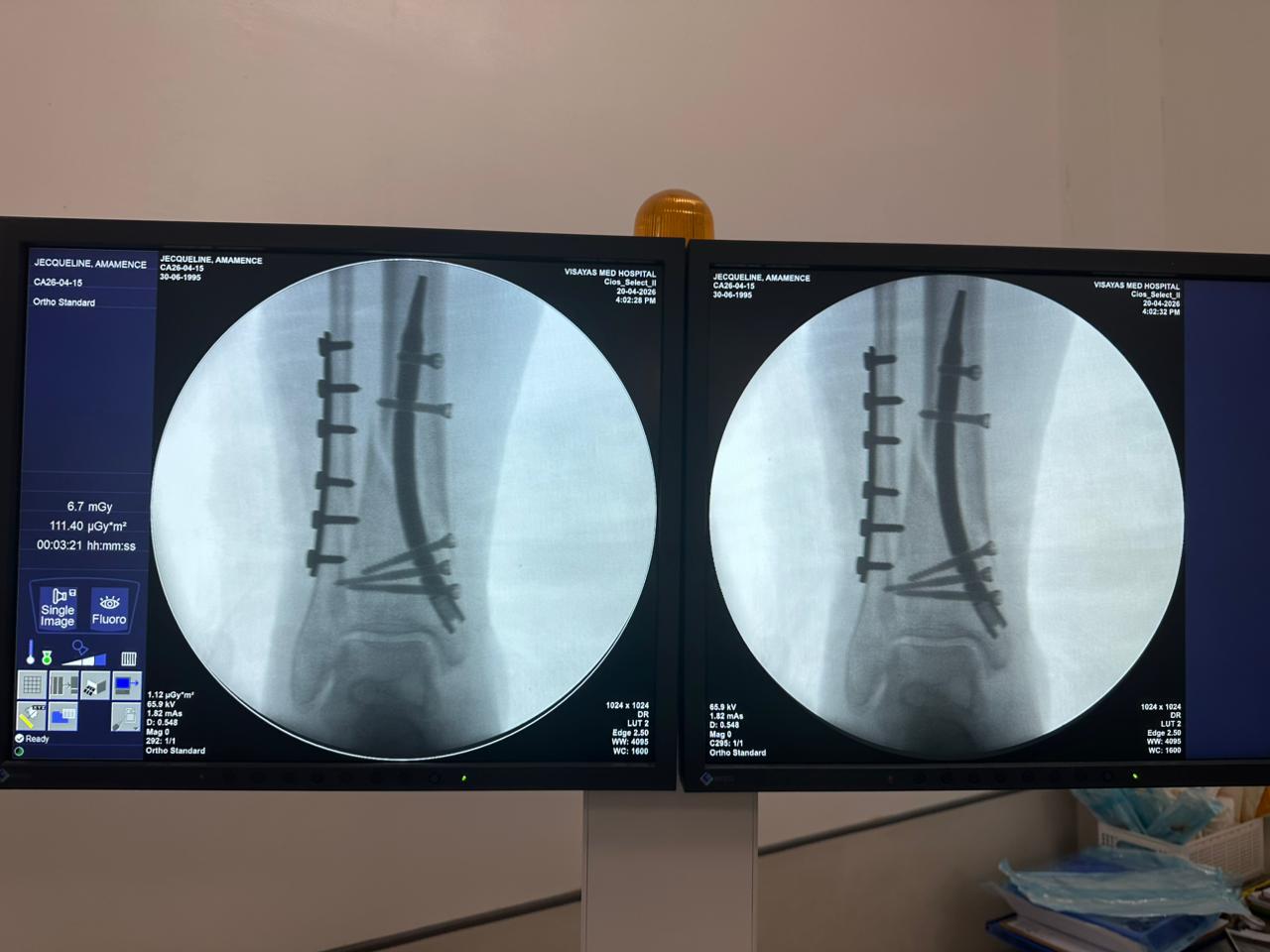 чехол для фиксации дистального отдела малоберцовой кости-CZMEDITECH
