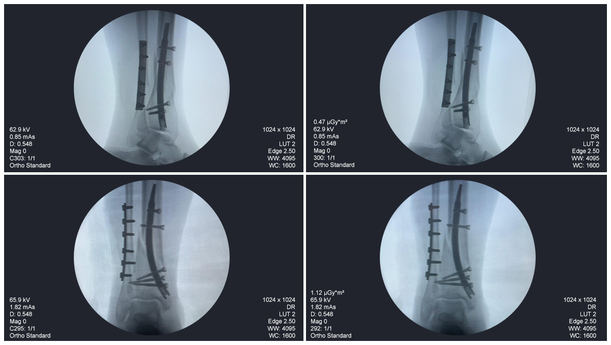 Дистальный гвоздь большеберцовой кости – 31 год